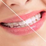 Thrive Dental and Orthodontics Dallas for Confident Smiles